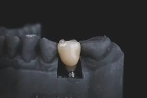 Tooth Extraction