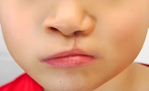 Cleft Lip and Palate Surgery